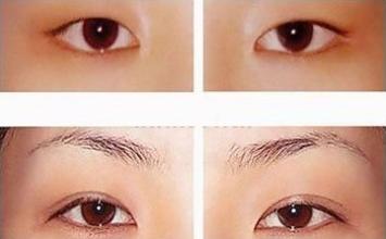 切开双眼皮对比照