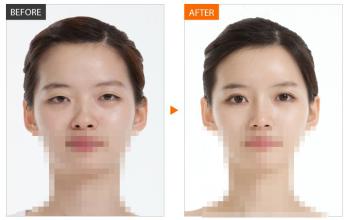 欧式双眼皮对比照