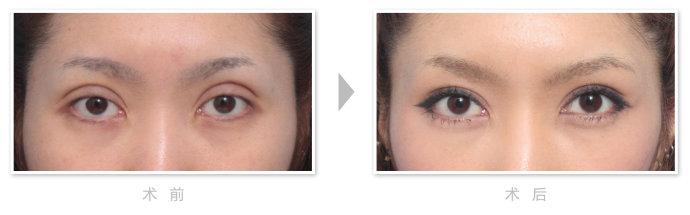 眼部手术修复对比照