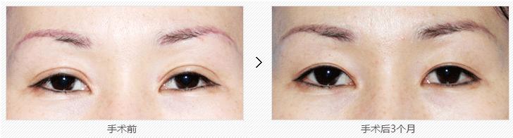 双眼皮修复对比照