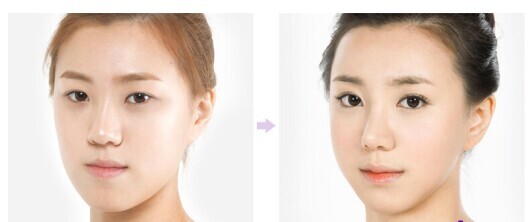 韩式双眼皮对比图