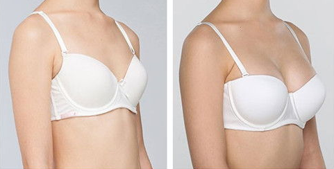 自体脂肪丰胸