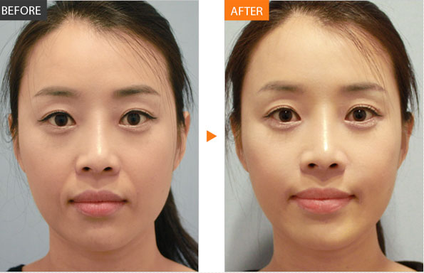 紧肤除皱对比照