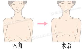 巨乳缩小对比照