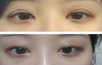 眼部修复术对比照