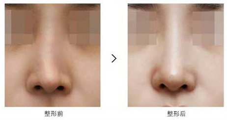 隆鼻术失败修复对比照