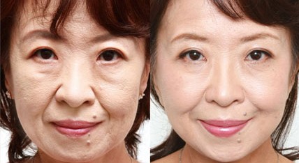 　电波拉皮对比照""