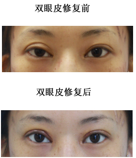 修复双眼皮对比照