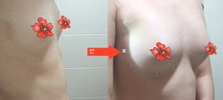 假体隆胸对比照