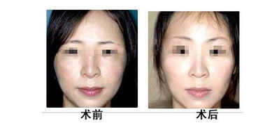 提眉术术后效果如何 - 珍美网