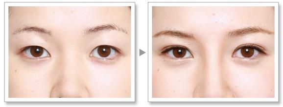 双眼皮手术费用是多少 - 珍美网