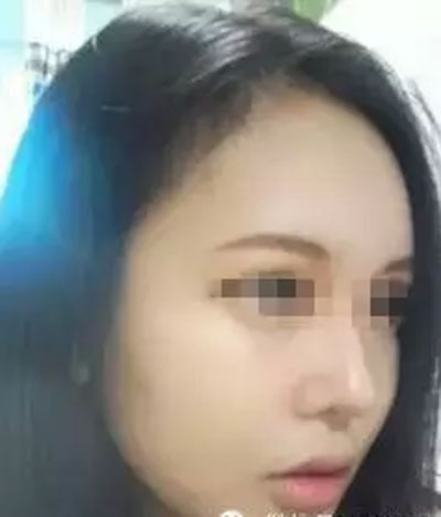自体脂肪面部填充 精致做个气质美女 - 珍美网
