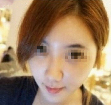 面部脂肪填充 变得气质美眉 - 珍美网