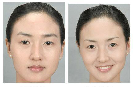 提眉的哪五种手术方法 - 珍美网