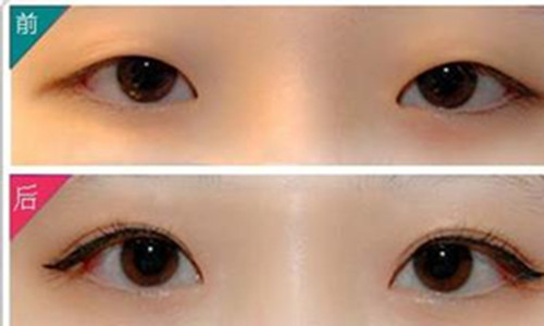 双眼皮整形术有哪些方法 - 珍美网