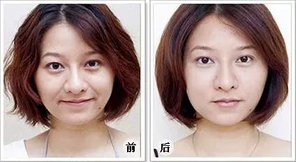 热玛吉除皱有什么优势 - 珍美网