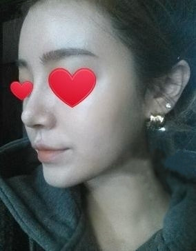 假体隆鼻 让自己更加自信美丽 - 珍美网