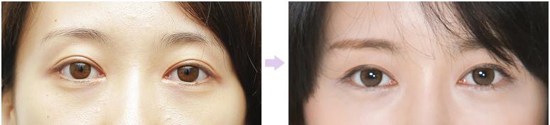 双眼皮手术的主要禁忌有哪些 - 珍美网