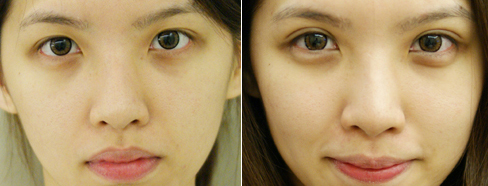 韩式双眼皮手术价格是多少 - 珍美网