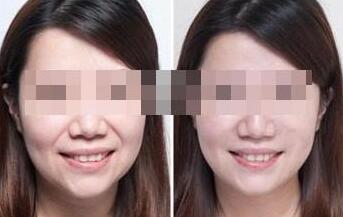 自体脂肪填充法令纹做几次 - 珍美网