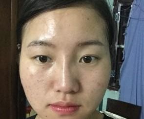 苏州工业园区瑞芙臣医疗美容诊所徐增亮医生丰全脸案例：面部填充 - 珍美网