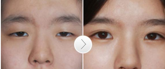 韩式双眼皮术后需要注意哪些问题 - 珍美网