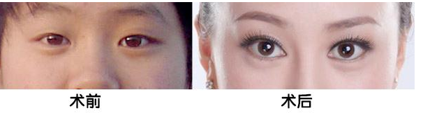 韩式双眼皮效果能维持多长时间? - 珍美网