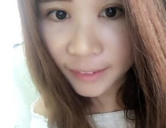 割双眼皮手术 让我更加美丽动人 - 珍美网
