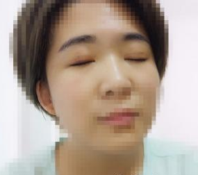 双眼皮手术  面部整体看起来美腻好多啊 - 珍美网