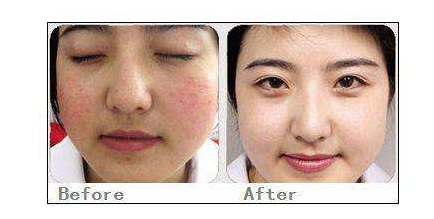 彩光嫩肤能坚持多久时间? - 珍美网