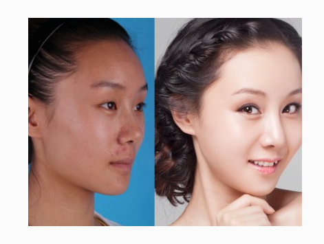 彩光嫩肤后会不会反弹呢 - 珍美网