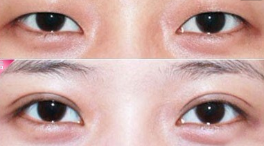 埋线双眼皮恢复期是多久? - 珍美网