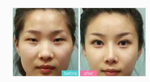 韩式双眼皮术后会不会留疤呢 - 珍美网