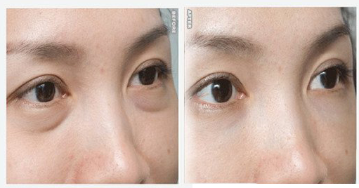 去除眼袋手术几天可以拆线呢 - 珍美网