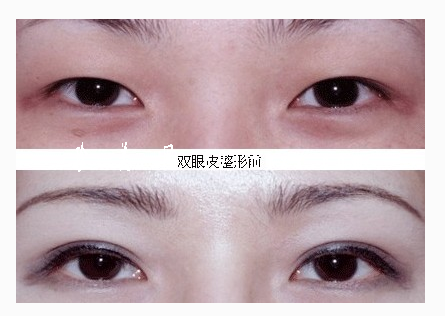 什么时间割双眼皮比较好呢 - 珍美网