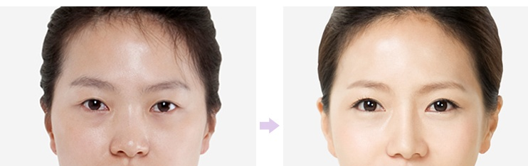 双眼皮手术消肿时间要多久呢 - 珍美网