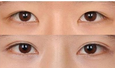 韩式双眼皮效果自然吗 - 珍美网