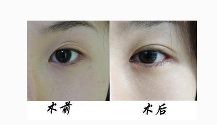 双眼皮失败修复手术多少钱 - 珍美网
