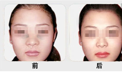 鼻翼缩小术效果怎么样 - 珍美网