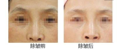 激光紧肤除皱效果怎么样 - 珍美网