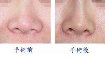 鼻翼缩小手术多少钱 - 珍美网