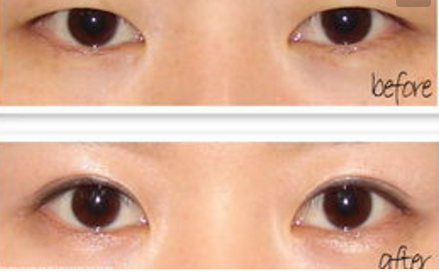 双眼皮手术效果怎么样呢 - 珍美网