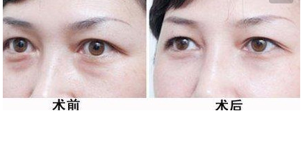 激光祛黑眼圈的好处有哪些 - 珍美网