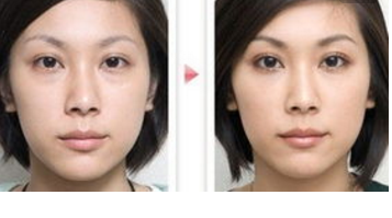 激光去眼袋手术效果好不好 - 珍美网