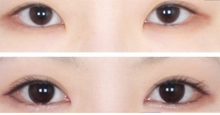 双眼皮失败修复手术效果怎么样 - 珍美网