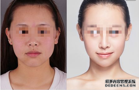光子嫩肤对比照