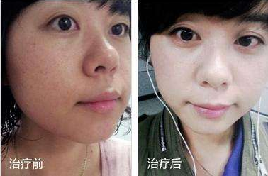 彩光嫩肤手术对比照