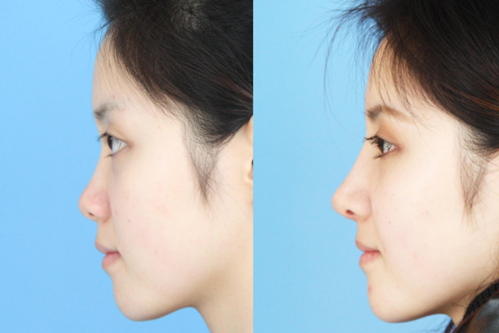 北京鼻综合整形手术需要多少钱?哪个医院好?_美啊美