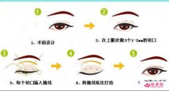 三点定位双眼皮多久恢复？护理能缩短恢复时间吗？