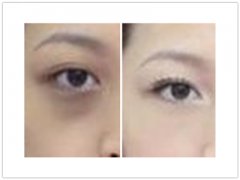 避免激光去黑眼圈的副作用_避免激光去黑眼圈有副作用的方法